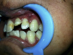 Fig 6. Final position of tooth after orthodontic extrusion.