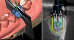 (Left) Translucent wax-up with center axis of planned implant trajectory for screwretained
single crown restoration. A one-piece screw-retained restoration is desired,
and the axial orientation from the implant plane through the occlusal table is decided.
Seating depth and trajectory of the implant platform is planned based on available
bone, soft tissue thickness, and both the cervical and occlusal design of the planned
restoration. (Right) Planning software shows scan of lower jaw seen in cross-section,
with view of inferior alveolar canal and lingual undercut. Salmon color line is surface
scan of cast showing depth of soft tissue at site. Blue outline of tooth is 2D surface
scan of wax-up with potential emergence profile as wax-up meets the cast, helping
determine depth of implant placement.