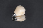 Full-contour zirconia restoration with titanium insert to be placed directly to implant as a one-piece assembly fixated with an abutment screw. Restoration is stained but has no veneering porcelain.