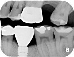 Bitewing radiograph 6 months after restoration is placed.