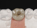 While this design of zirconia restoration has the ability to re-orient the screw-access hole within 25°, this feature was not required with planning and implant placement for this patient.