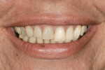 Figure 9  Image of a lower one third smiling exposure that has been digitally altered with Photoshopon the patient’s left maxillary only.