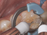 SureFil® SDR® flow Posterior Bulk Fill Flowable Base was dispensed, completely covering the margins of the box and 1 mm of the pulpal floor.