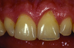 Fig 1. Preoperative photo showing chipped and worn anterior teeth.