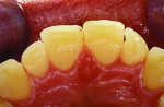 Fig 2. Retracted pre-op view of teeth in MIP.