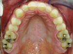 Fig 4 and Fig 5. Occlusal views of the patient at initial presentation.