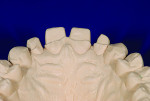 Fig 8. Palatal view of tooth preparations with finish lines at the apical extent of the wear facet.