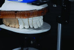 Fig. 13 Cross-mounted working model; the physical references from the articulator can now be used to design the final restorations to duplicate the tooth position of the provisional.
