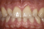 Fig 1. Preoperative view showing chipped and worn teeth.