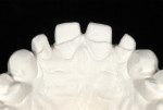 Fig 9. Palatal view of the tooth preparations with ﬁnish lines at the apical extent of the wear facets.