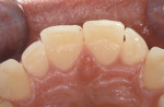 Fig 8. Pretreatment maxillary cast; note the wear facets incisal to the cingulums.