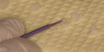 Figure 14  Adhesive resin is applied to the bonding surfaces of the porcelain veneers.