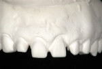 Fig 10. Model of the tooth preparations.