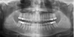 Fig 3. Panoramic radiograph showing the patient at initial presenta-tion.