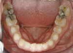 Fig 5. Mandibular occlusal view;  note the incisal wear pattern on the incisors and cuspids.