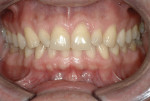 Fig 2. Full retracted preoperative view of teeth in MIP.