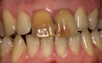 Fig 1. Patient’s chief concerns were extensive discolorations of teeth Nos. 8 and 9.
