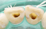 Fig 4. Tooth canals cleaned and irrigated, with old paste materials all cleared away