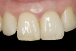 Fig 12. Three weeks after internal bleaching and restora-tion of teeth Nos. 8 and 9.