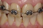 Fig 13. Six years after internal bleaching therapy, the patient presented after orthodontic treatment with only slight discoloration recurrence.