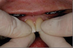 Figure 17  The index fingers are placed on the incisal edges while the thumbs are placed on the labial surfaces to fully seat the restorations.