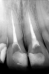 Fig 9. In this x-ray of teeth Nos. 8 and 9 after retreatment and barrier placement, the semilunar shape of the bar-rier can be seen.