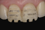 Fig 14. The veneer preparation of teeth Nos. 8 and 9 utilized a composite mock-up in order to minimize the amount of tooth structure removed.