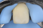 Fig 15. Rubber dam isolation before cementation of the porcelain veneer.