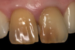 Fig 2. Close-up view of discolored teeth Nos. 8 and 9.