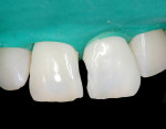 Fig 11. Bleached teeth Nos. 8 and 9 isolated with a rubber dam before restoration.