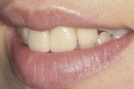 Fig 20. Final smile of the patient in harmony with the lips after internal bleach-ing and veneer therapy.