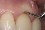 Fig 18. Delicate subgingival preparation without violating biological width. This enabled healthy gingival tissue around the veneer, appropriate coverage of the darker tooth structure, and predictable professional hygiene. (Note: Hand scaling can be effectively performed with a proper understanding of the veneer cervical margin.)
