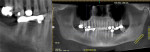 Fig. 17 Pre-extraction panoramic and periapical views, teeth Nos. 28, 30, and proposed implant sites.