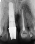 Figure 5  Post restoration, 1-year follow-up x-ray.