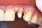 Figure 6  The new crown preparation. The tooth has been rebuilt with Spee-Dee Build-Up. Note that the design is less rounded and less tapered to maximize retention form.