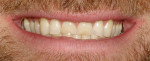 Figure 1  The pretreatment smile view shows the uneven wear of the maxillary anterior teeth. Note how the finer nails must have been turned sideways to affect the loss pattern on the mesial of both laterals.