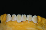 Fig 7. The use of opacious dentin material adds chroma or supports the value of dentin material.