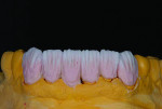 Fig 8 and Fig 9. For this case, a higher chroma dentin is applied cervical and interproximal with higher-value dentins placed in the mid-third.