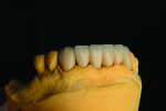 Fig 14 through Fig 17. Restorations on the model before and after polishing.