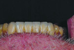 Fig 18 through Fig 20. Definitive restorations seated in the mouth.