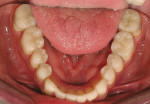 Figure 9  The posterior IPS Empress overlays were cemented after filling removal and surface preparation. The mandibular anterior teeth were overlaid with temporary resin, creating trial temporaries.