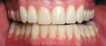 Figure 13  The mandibular arch fully restored, with maxillary temporaries on teeth Nos. 6 through 11.