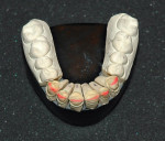 Figure 14  Palatal view of the preparations compared with Figure 4 shows little reduction was needed on the palatal aspect of the anterior six teeth.