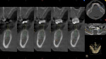 Various views provided by the CBCT images
facilitated implant placement planning from multiple dimensions.