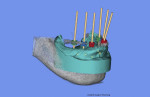 CBCT planning included CAD/CAM analysis for creating a surgical guide.