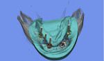 View of a virtual model demonstrating ideal implant location and angulation.