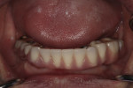 All implants were immediately loaded with a fixed hybrid chairside denture.