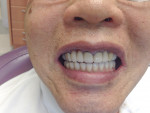Final postoperative view of the zirconia fixed
hybrid denture.
