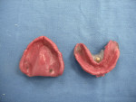 Maxillary and mandibular impressions.