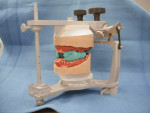 Cast mounted arbitrarily within the articulator.